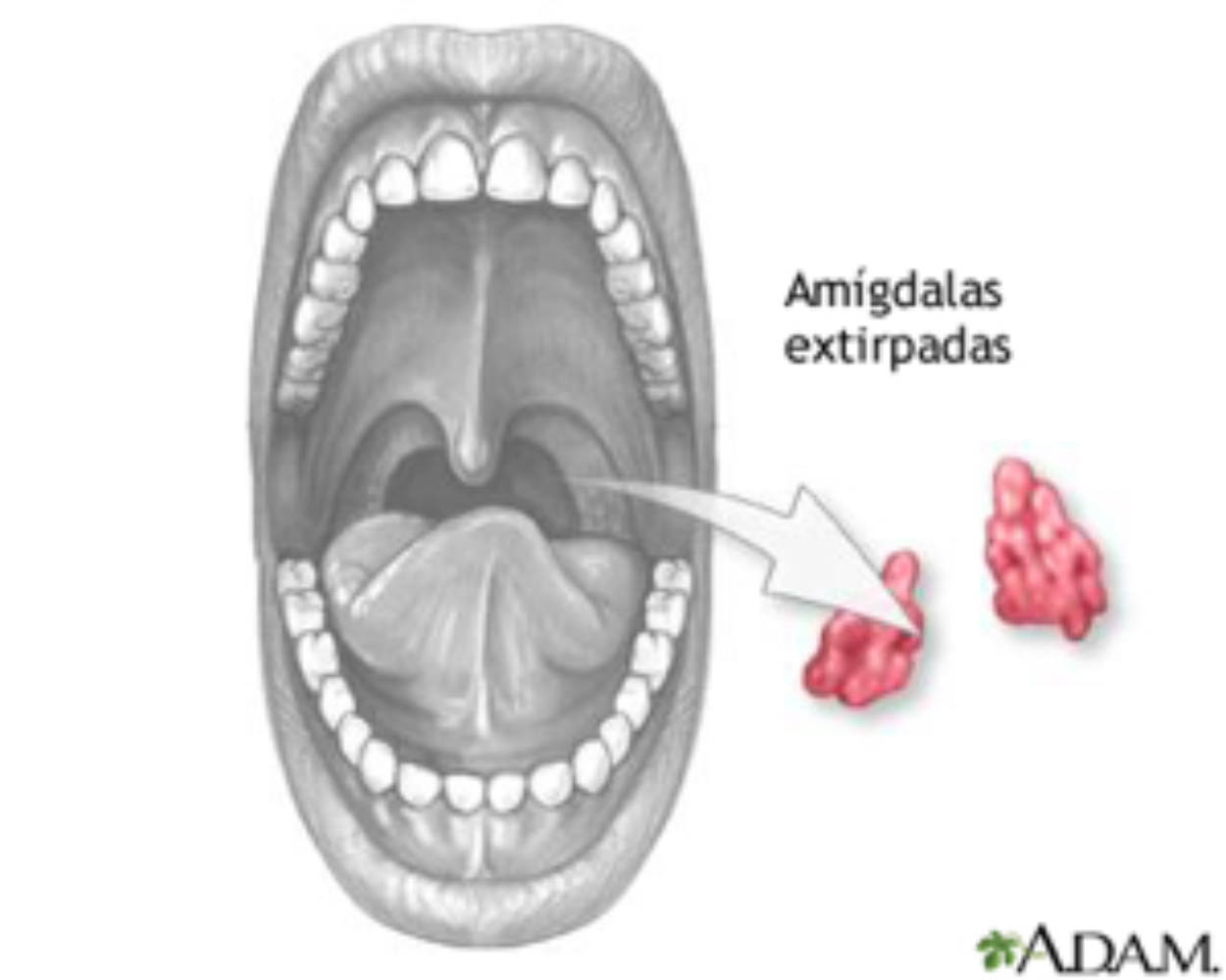 amigdalectomia