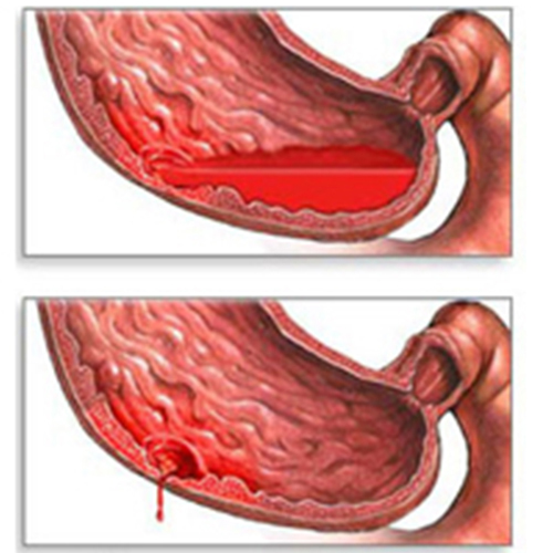 Язвенное Кровотечение Диета