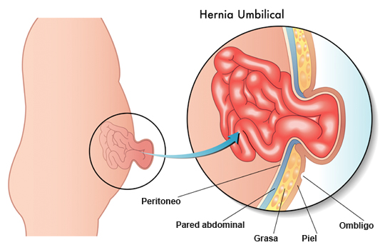 rinoplastia