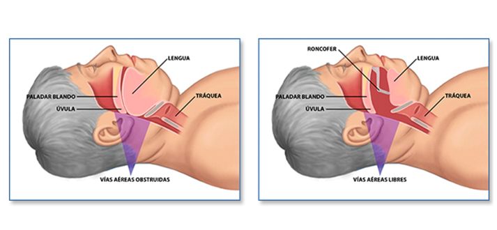 Cómo Dejar de Roncar Sin necesidad de Cirugía - Arques Clinic
